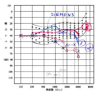 補聴器調整結果(聞こえ方)