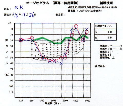 「お椀型」と思われる特異型オージオグラムへの補聴器適合例