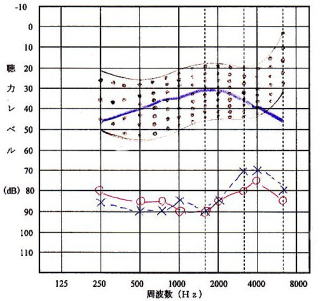 日本初、スーパーパワーチャネルフリー補聴器＋ワイヤレス使用者の聞こえデータ