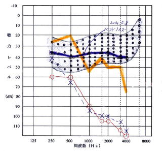 周波数シフト機能付補聴器による驚異的結果